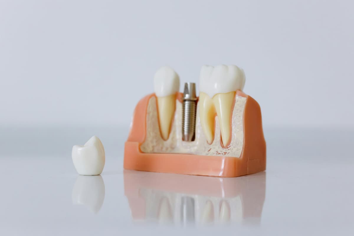 Implant Restoration