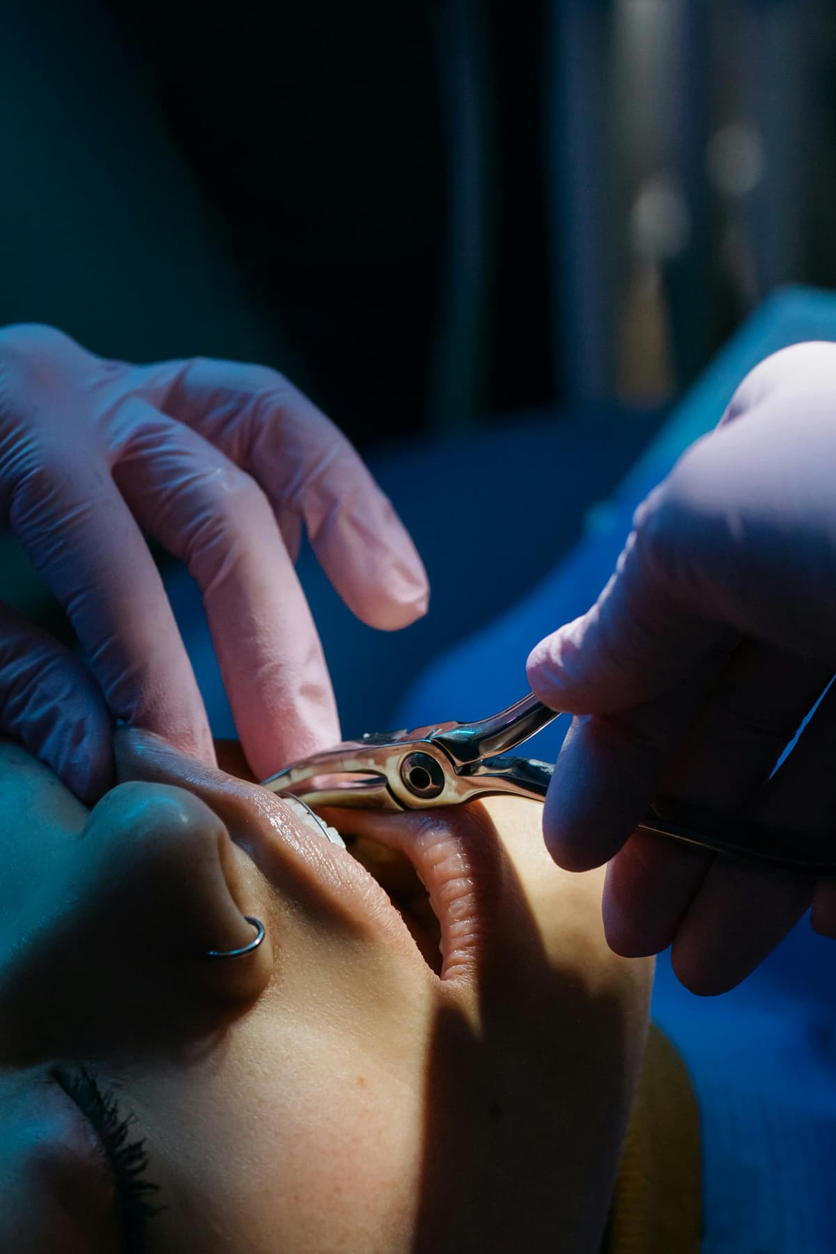 Extractions