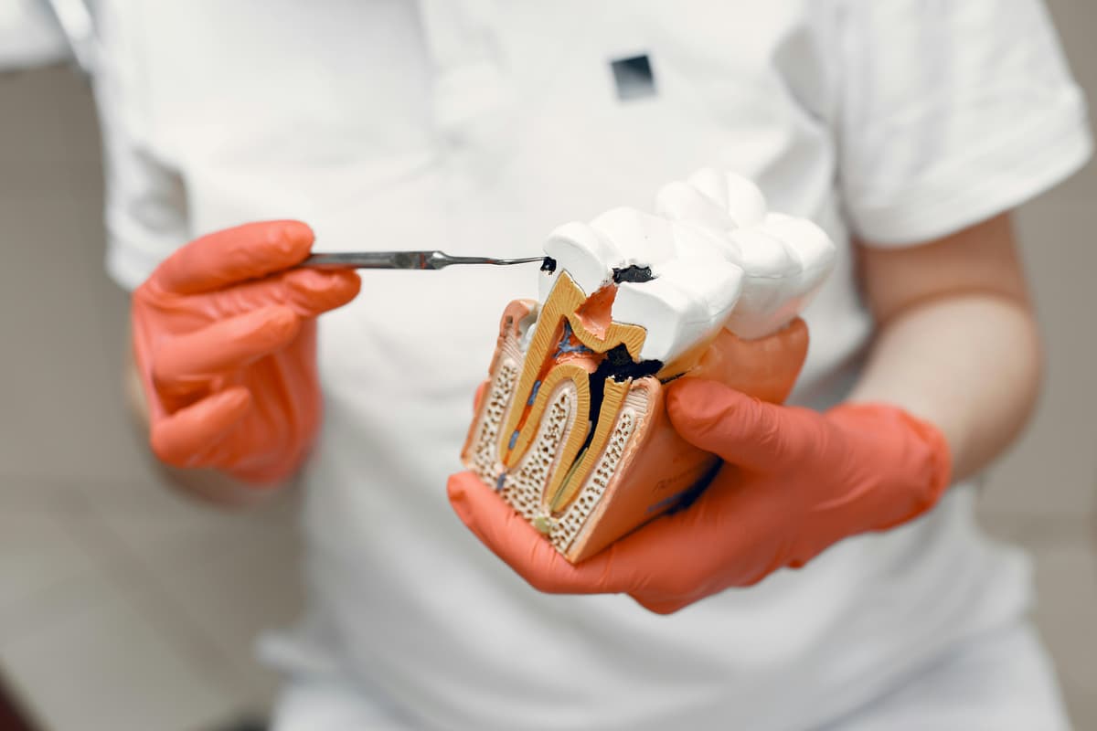 Root Canals